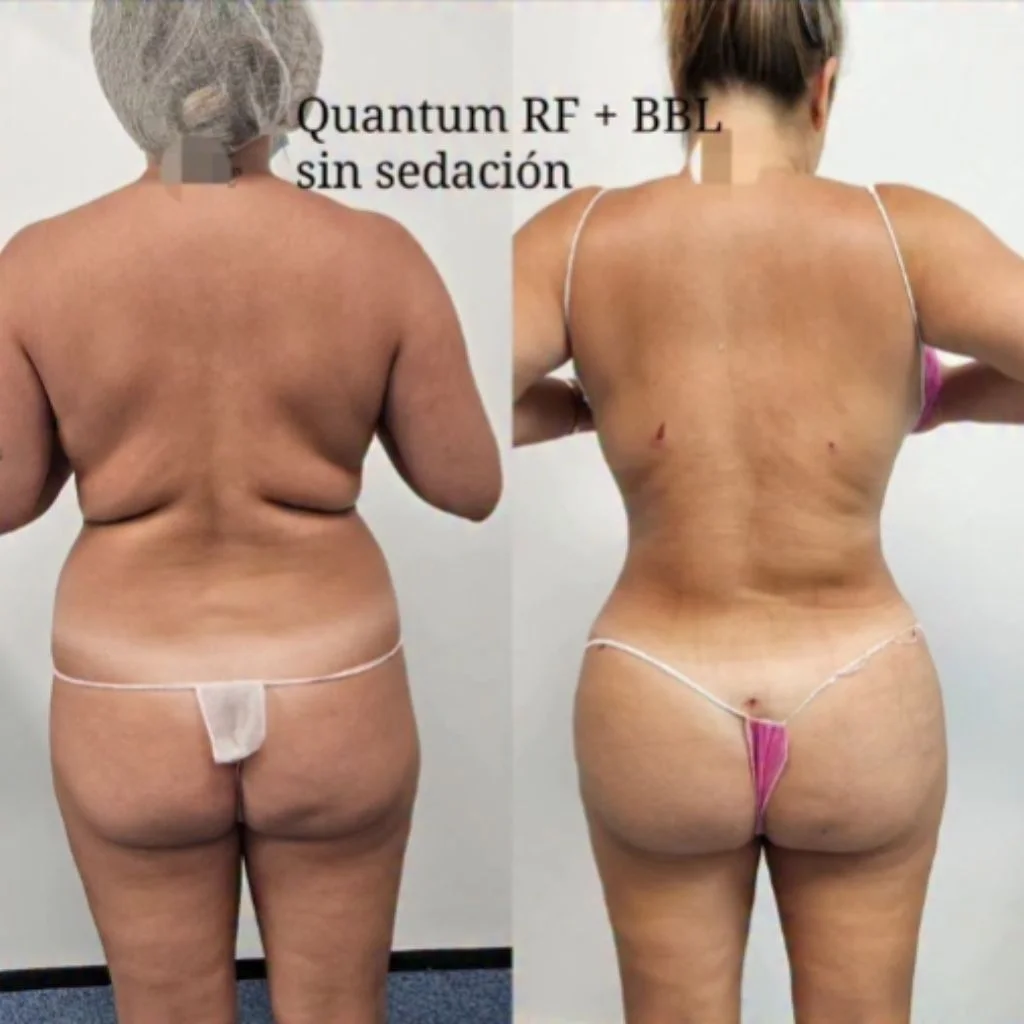 Antes y Después BBL