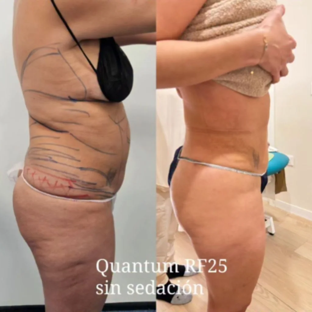 Lipoescultura Radiofrecuencia