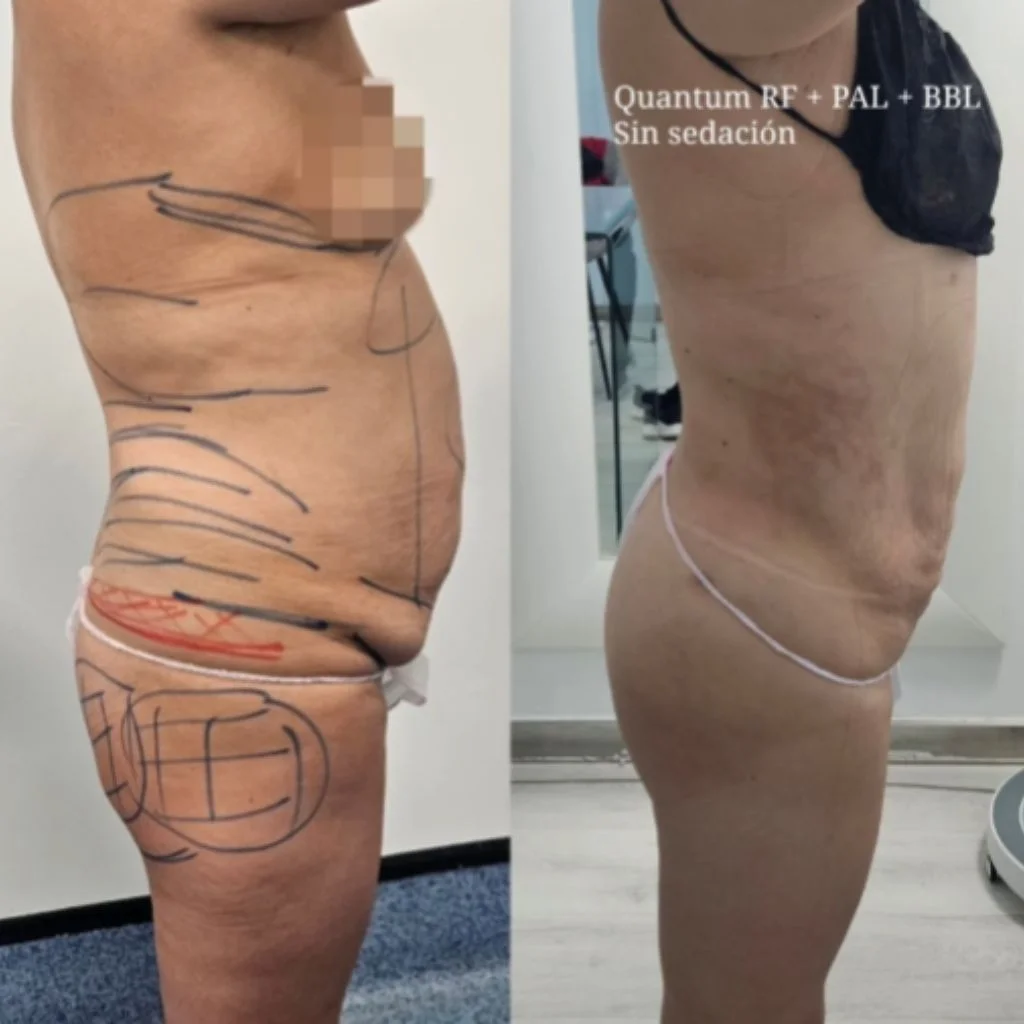 Lipoescultura radiofrecuencia 2