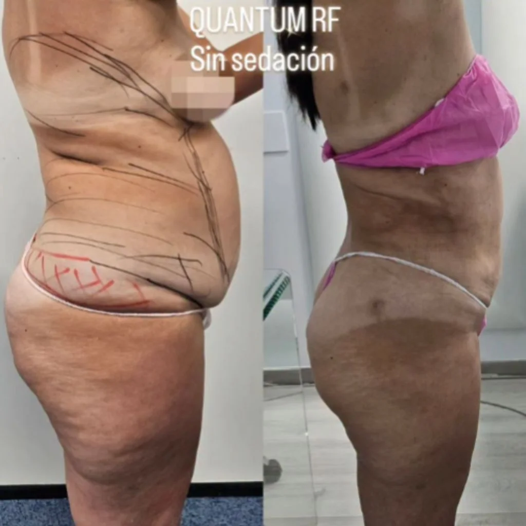 Lipoescultura Radiofrecuencia 3