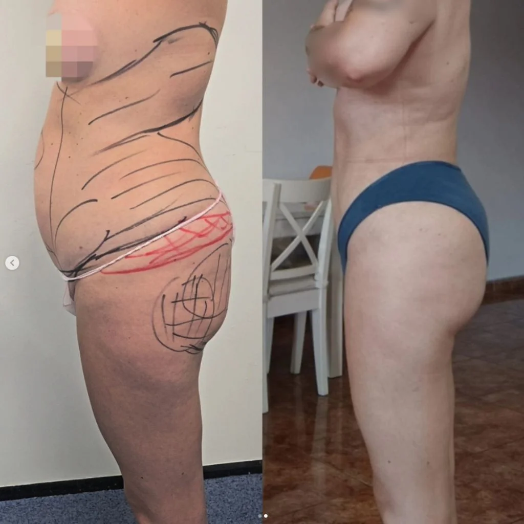 Liposucción Radiofrecuencia 4