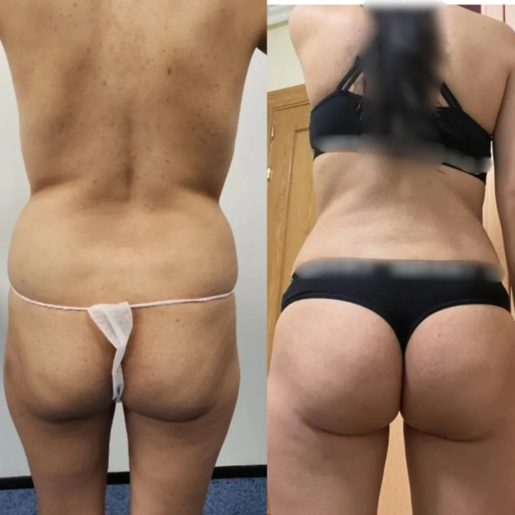 Lipotransferencia BBl
