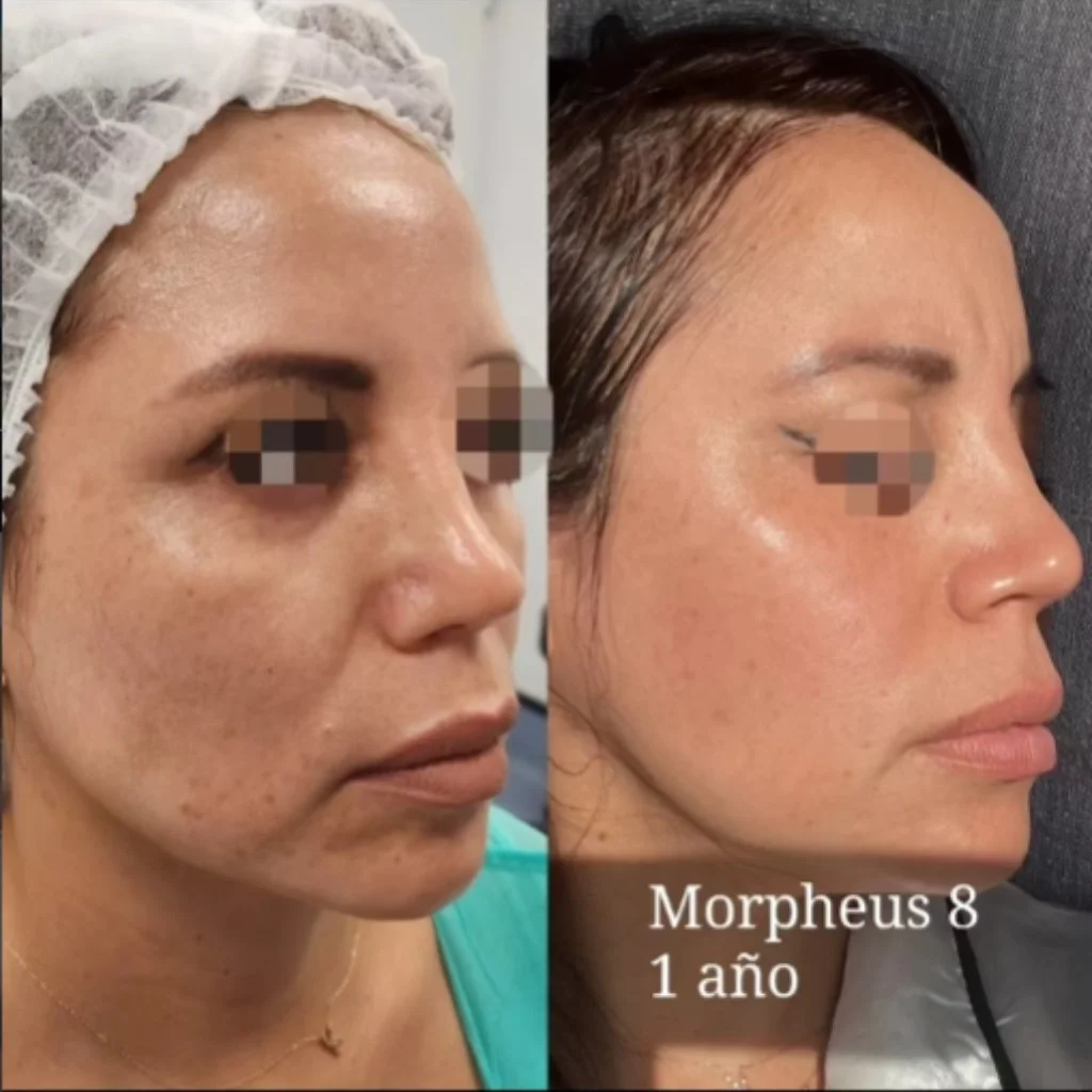 Resurfacing Co2